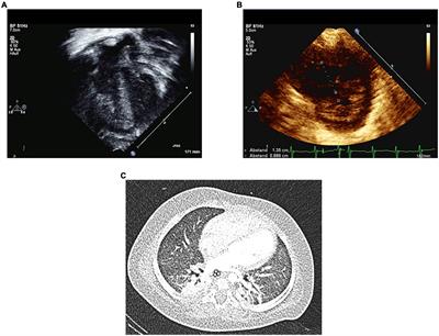 Case report: Rescue treatment with add-on selexipag in a preterm infant with suprasystemic pulmonary hypertension, pulmonary capillary hemangiomatosis, and isolated pulmonary vein stenosis